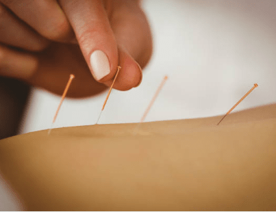 acupuncture-05